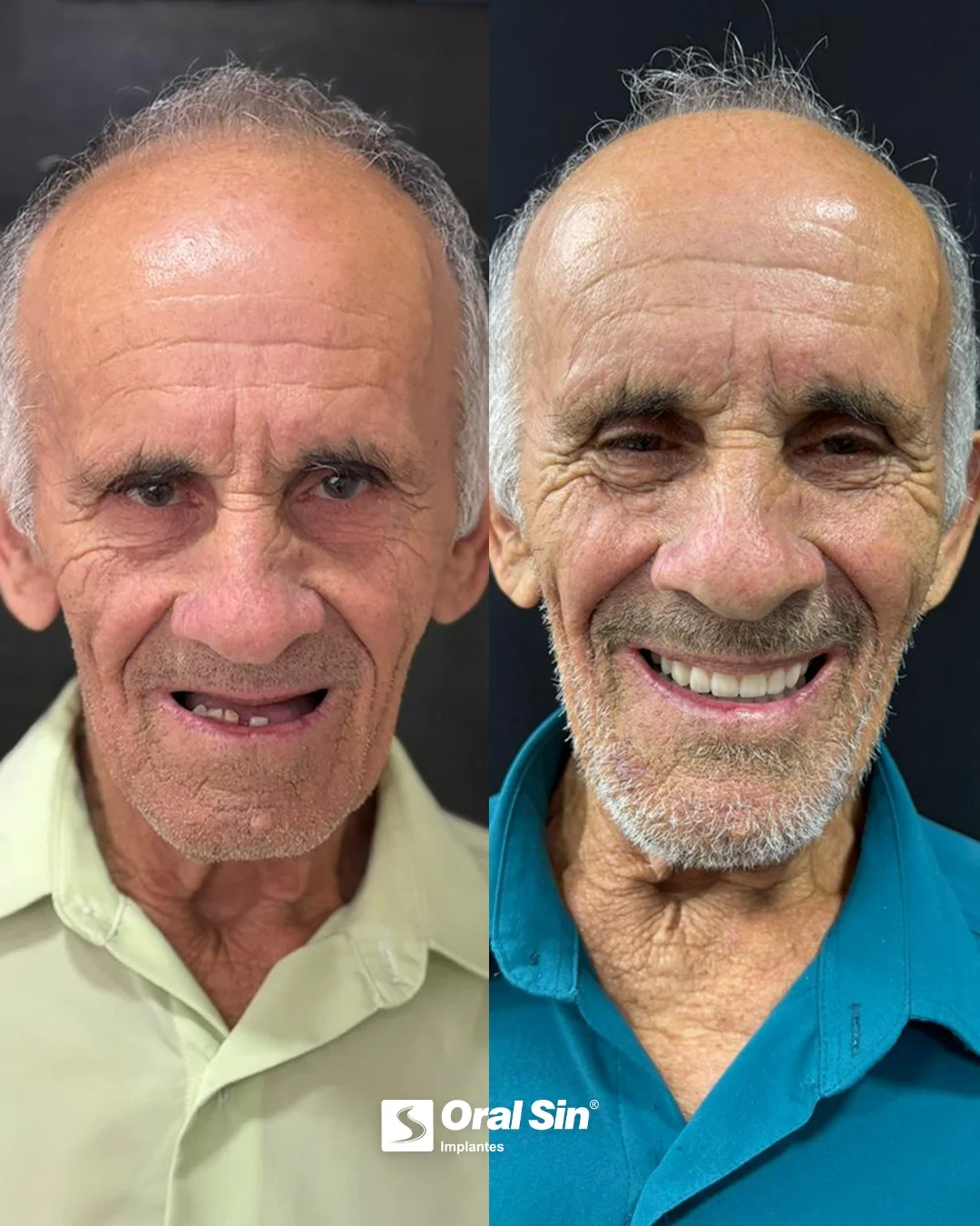 Antes e depois — caso 1 de implantes/prótese na Oral Sin