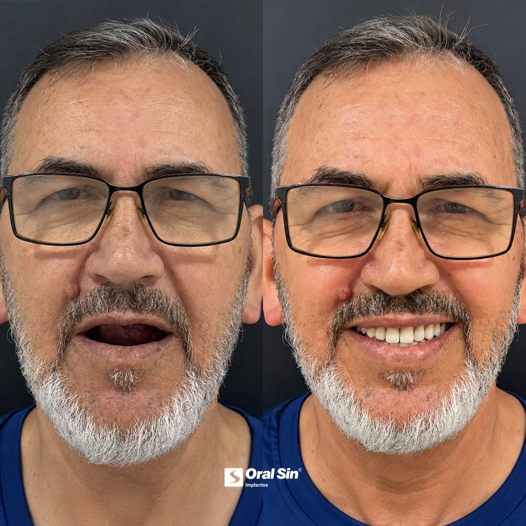 Antes e depois — caso 2 de implantes/prótese na Oral Sin