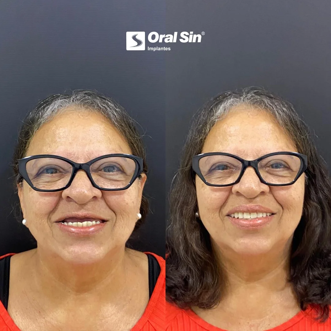 Antes e depois — caso 3 de implantes/prótese na Oral Sin