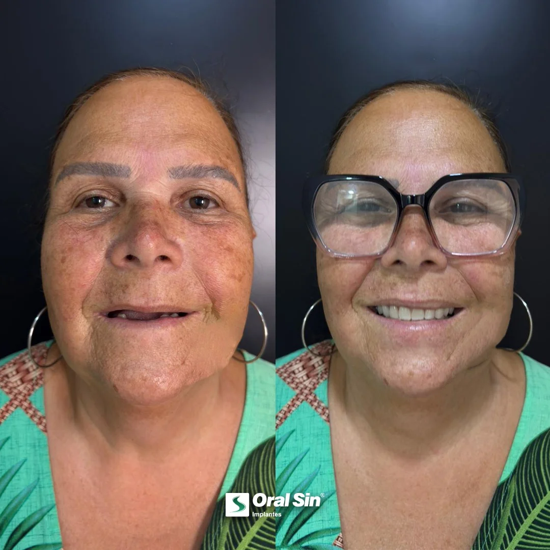 Antes e depois — caso 4 de implantes/prótese na Oral Sin