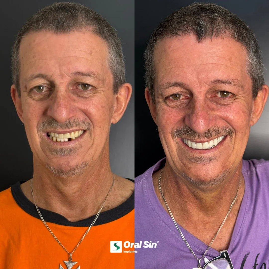 Antes e depois — caso 5 de implantes/prótese na Oral Sin
