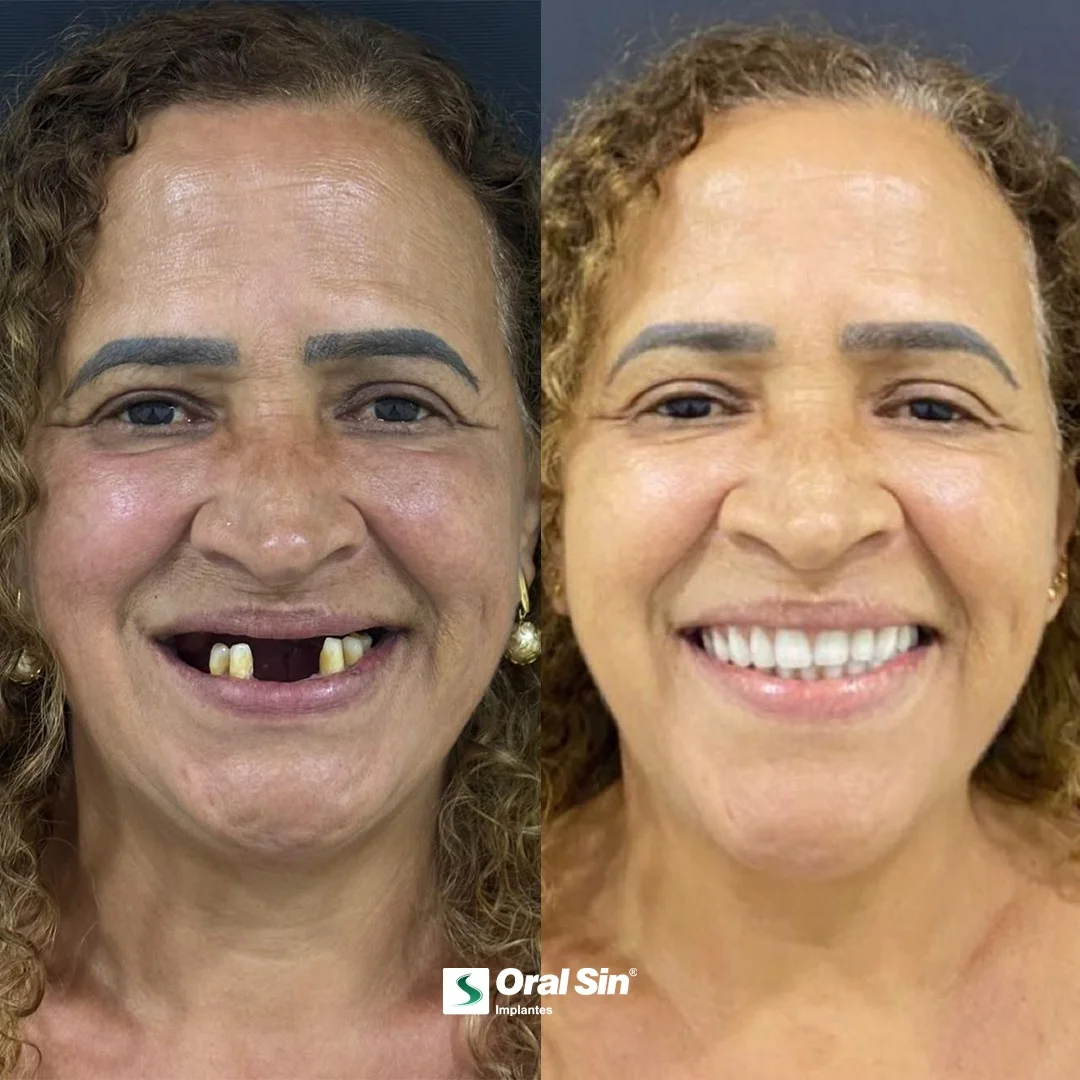 Antes e depois — caso 6 de implantes/prótese na Oral Sin