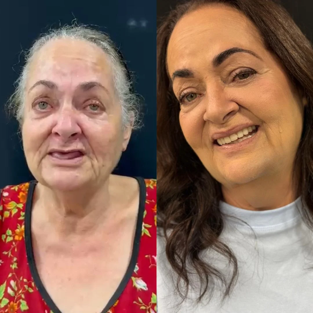 Antes e depois — caso 7 de implantes/prótese na Oral Sin