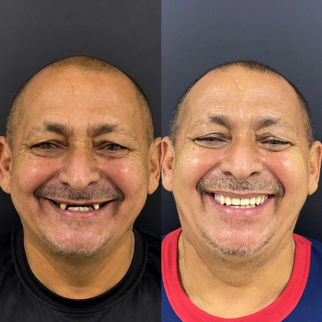Antes e depois — caso 8 de implantes/prótese na Oral Sin