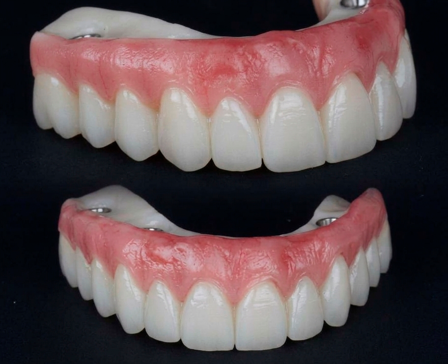 Prótese protocolo sobre implantes