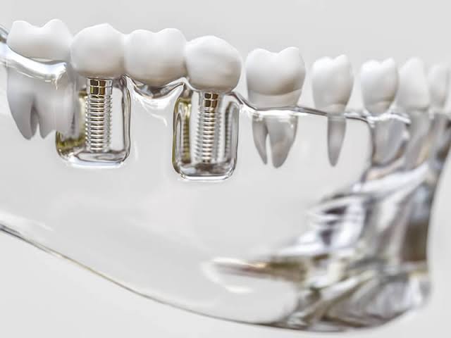 Implante dentário e coroa cerâmica