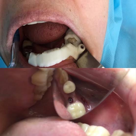 Cirurgia de implante dentário