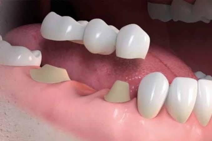 Comparação entre implante e ponte dentária