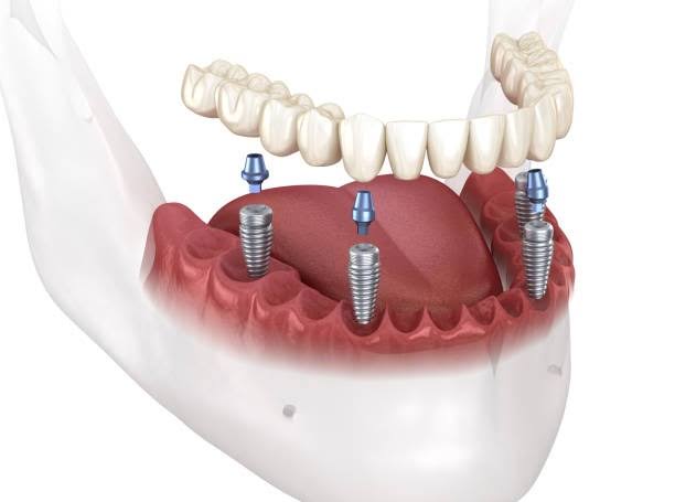 Carga imediata — dentes fixos no mesmo dia