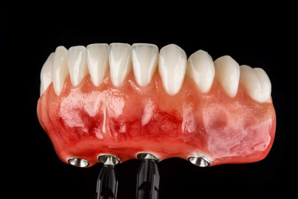Cuidados para evitar a falha do implante dentário